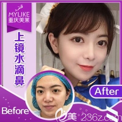 重慶美萊哪個(gè)醫(yī)生隆鼻好 重慶美萊哪個(gè)醫(yī)生隆鼻好