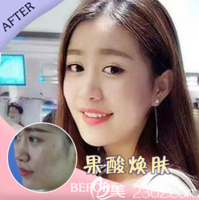 陳恒君果酸嫩膚 陳恒君果酸嫩膚