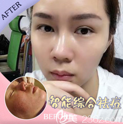 重慶美萊祛痘效果好不好 重慶美萊祛痘效果好不好