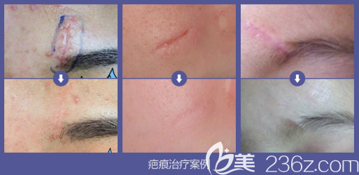 彭代智去疤好不好 彭代智去疤好不好