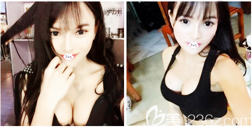 看了東莞豐胸醫(yī)院排名后花兩萬多元找東莞美立方李志剛做了玉兔動感隆胸手術(shù)