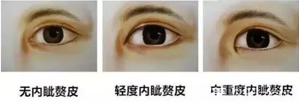 不同程度有內眥贅皮的眼睛