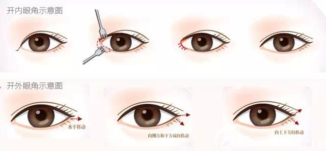 傳統(tǒng)的開眼角手術原理