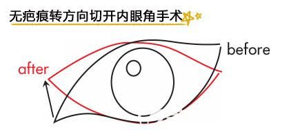 韓式無痕開眼角原理