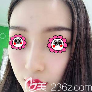 北京圣嘉新隆鼻怎么樣？我找圣嘉新黃海濱做耳軟骨隆鼻第25天效果參考