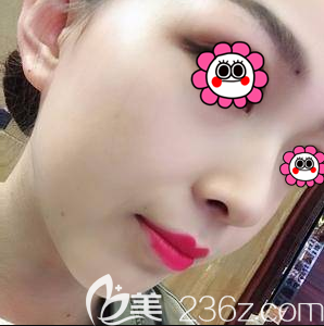 北京圣嘉新耳軟骨鼻綜合隆鼻案例