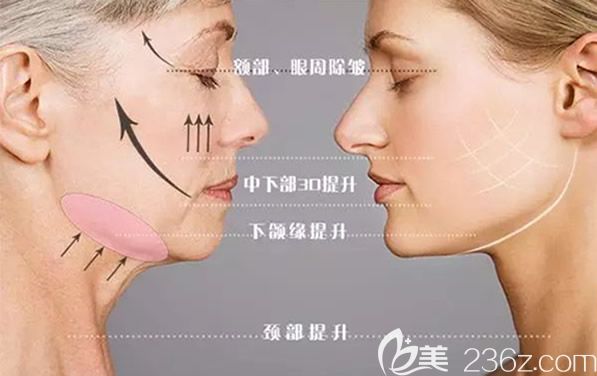 線雕適合的部位