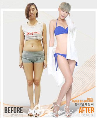 韓國(guó)365mc吸脂醫(yī)院案例