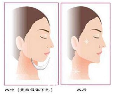 做假體墊下巴術(shù)前術(shù)后對(duì)比照