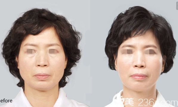 線雕提升一周后的圖片