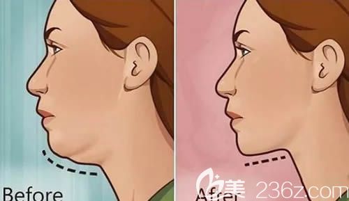 高新丹醫(yī)生解答牙齒矯正是否會改變臉型 高新丹醫(yī)生解答牙齒矯正是否會改變臉型