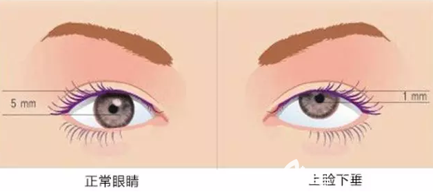 正常眼睛和上瞼下垂展示圖