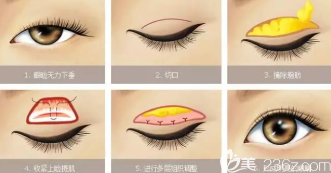 上瞼下垂矯正手術(shù)過(guò)程圖