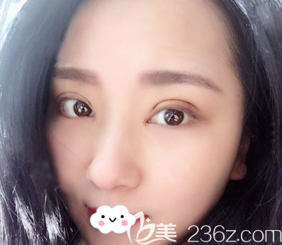 張玲雙眼皮開眼角術(shù)后3天