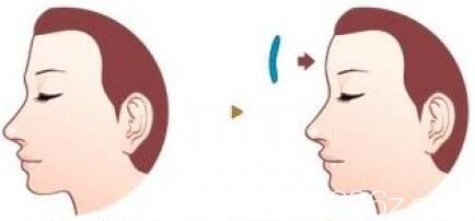 假體豐額頭安全嗎？