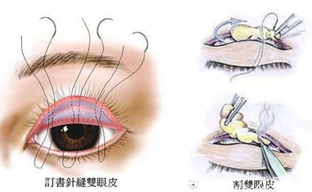 雙眼皮切割脂肪的樣子