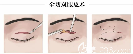 全切雙眼皮手術(shù)