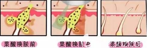 果酸換膚術(shù)后護(hù)理