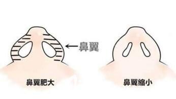 鼻翼縮小術(shù)前術(shù)后對(duì)比效果