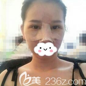 做眼綜合+鼻綜合術(shù)后第3天