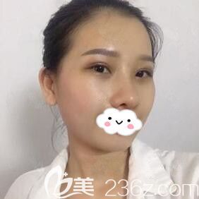 在華美做眼綜合+鼻綜合術(shù)后第8天恢復(fù)效果