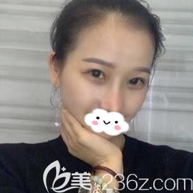 還在糾結(jié)鼻綜合和眼綜合要不要一起做，看我在海南華美做的效果變化不要太大哦！