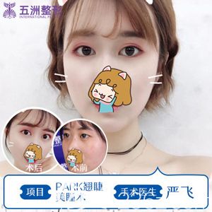 嚴(yán)飛院長(zhǎng)做雙眼皮術(shù)前術(shù)后變化明顯