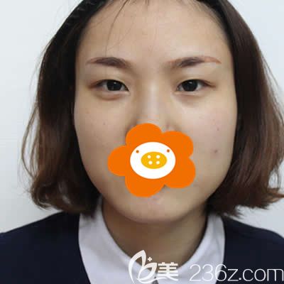 在<!--<i data=20240703-sp></i>-->找張慧慧醫(yī)生做雙眼皮前的我 在<!--<i data=20240703-sp></i>-->找張慧慧醫(yī)生做雙眼皮前的我