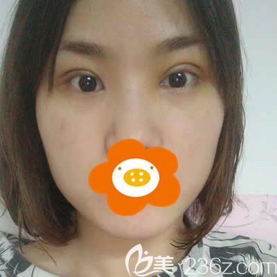 我找<!--<i data=20240703-sp></i>-->張慧慧醫(yī)生做雙眼皮術(shù)后半月后照片 我找<!--<i data=20240703-sp></i>-->張慧慧醫(yī)生做雙眼皮術(shù)后半月后照片