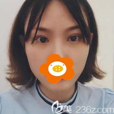 我找<!--<i data=20240703-sp></i>-->張慧慧醫(yī)生做雙眼皮術(shù)后30天效果展示 我找<!--<i data=20240703-sp></i>-->張慧慧醫(yī)生做雙眼皮術(shù)后30天效果展示