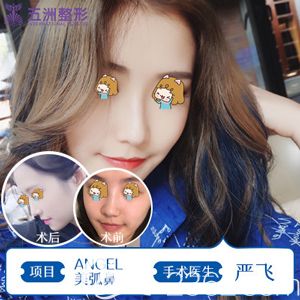 嚴(yán)飛做鼻部整形術(shù)后鼻子明顯變挺