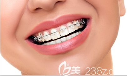 姜丹醫(yī)生帶大家解開有關牙齒矯正的謠言