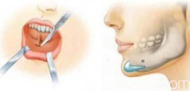 假體墊下巴手術(shù)示意圖 假體墊下巴手術(shù)示意圖
