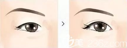 雙眼皮和開眼角一起做術后效果