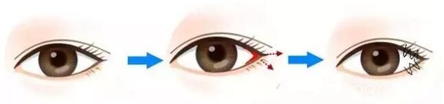 開外眼角手術原理