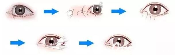 開內眼角手術原理