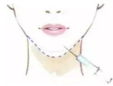 玻尿酸豐下巴幾天能消腫？