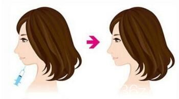 玻尿酸豐下巴前后效果對(duì)比