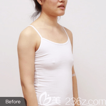 我在北京圣嘉新做維密脂肪豐胸前樣子 我在北京圣嘉新做維密脂肪豐胸前樣子