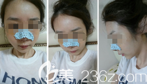 張偉醫(yī)生為我剛做完立秀膨體隆鼻術(shù)后鼻子微腫