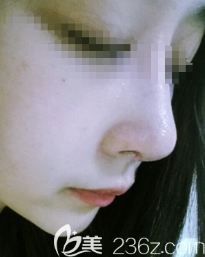 在邯鄲京美做膨體隆鼻術(shù)后一周鼻子拆線