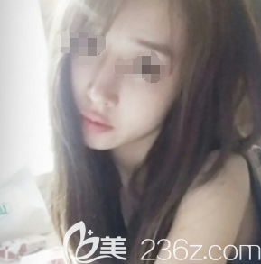 張偉醫(yī)生為我做膨體隆鼻術(shù)后20天鼻子消腫