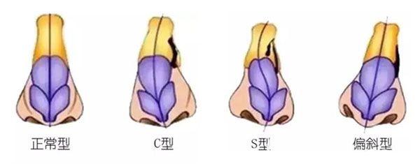 正常鼻型與歪斜鼻型對比示意圖