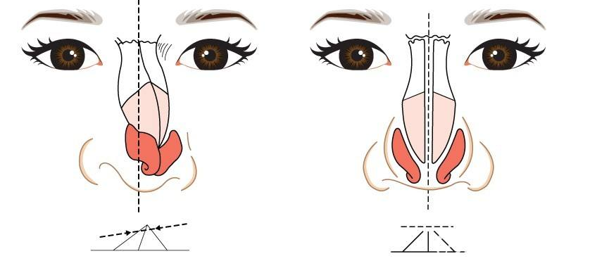 韓國歪鼻矯正示意圖