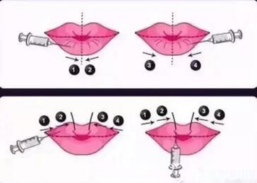 玻尿酸豐唇過(guò)程示意圖