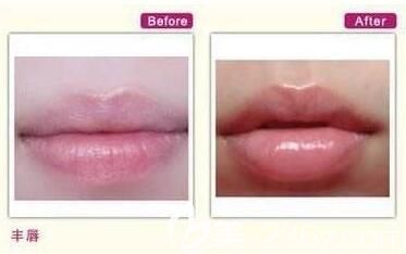 玻尿酸豐唇前后對(duì)比照