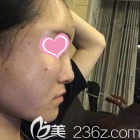 做自體脂肪填充面部術(shù)后3天