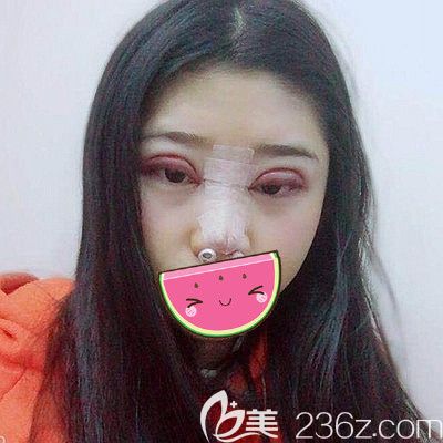 在南陽維多利亞做雙眼皮和隆鼻3天后的改變