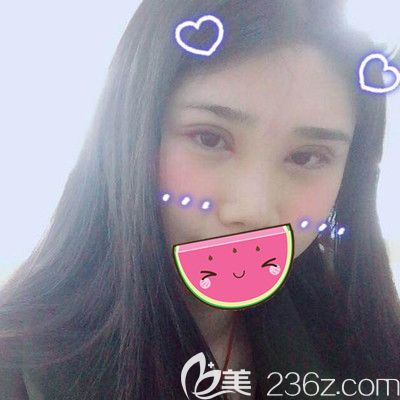 做全切雙眼皮和硅膠假體隆鼻后7天的樣子