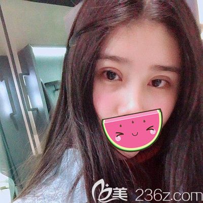 做全切雙眼皮和硅膠假體隆鼻1個(gè)月后的改變是我這趟南陽(yáng)之旅的超值收獲